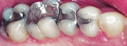 Before By assessing the worn out fillings with the use of enlarged images from the intra-oral camera, the patient becomes a partner in their own diagnosis, since it is quite obvious which fillings