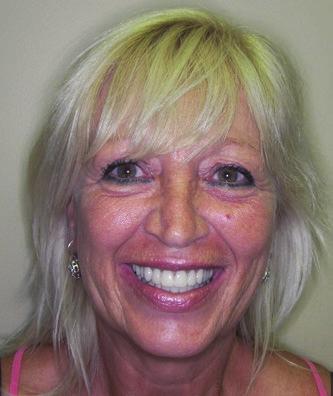 Dental Implant Transformation Unsightly, failing teeth on this active lady.