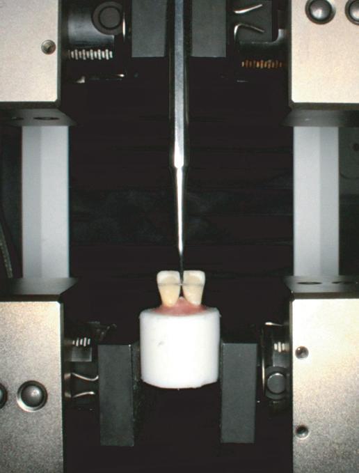 for placement of the wire in the middle of the composite bulk. The tip of the light curing unit was placed as close as possible to the surface of the tooth.