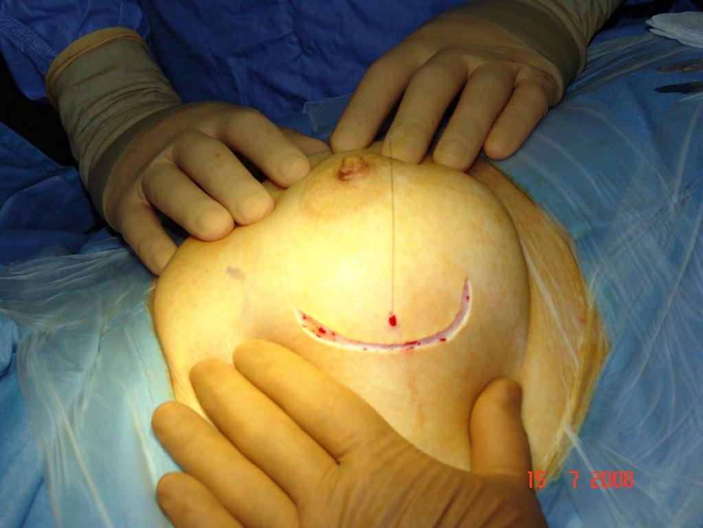 Skin incision is made by