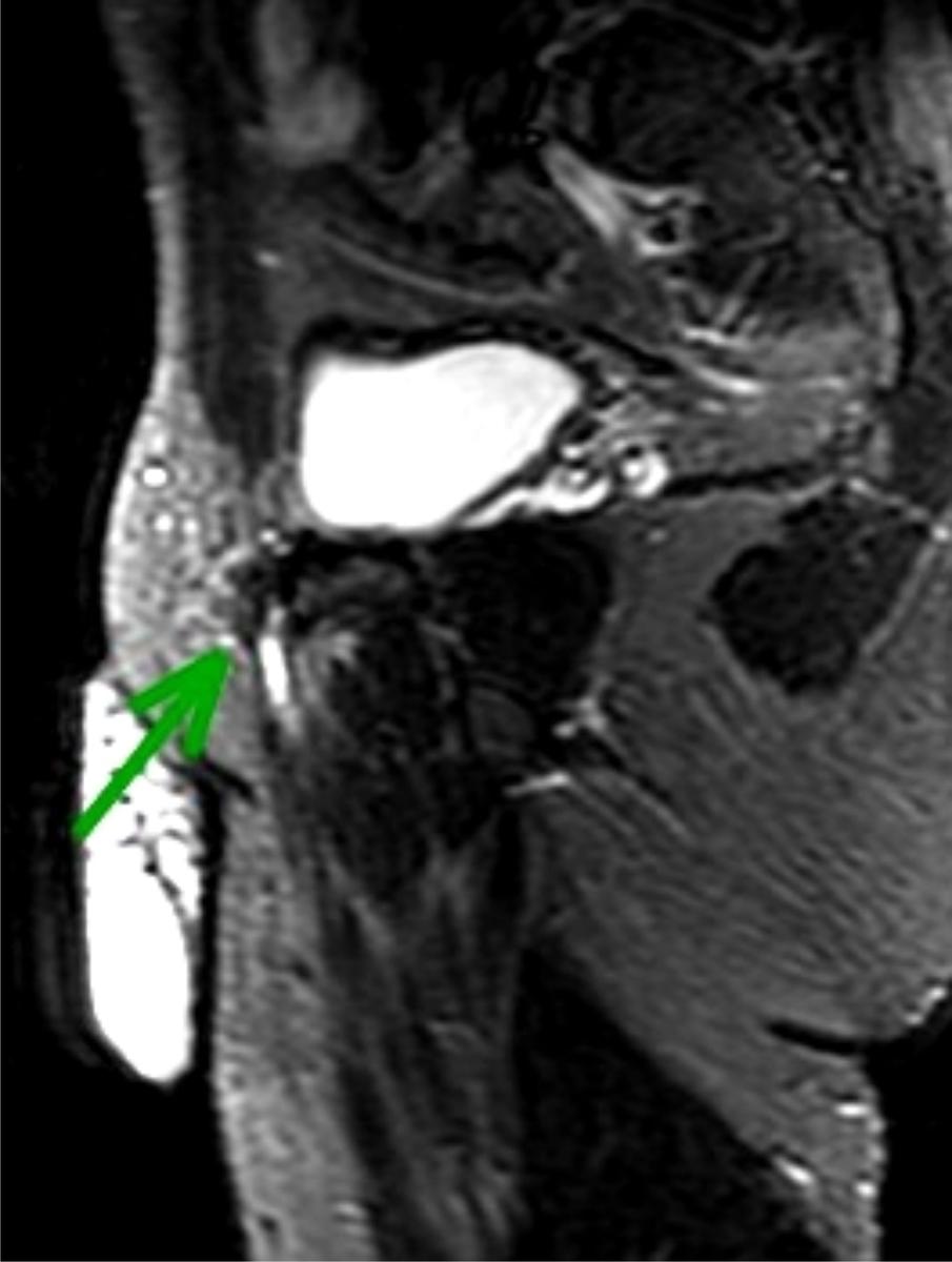 Fig. 5: Tear of the left rectus abdominis-adductor longus aponeurosis in a 24-year old football player with left-sided athletic pubalgia.