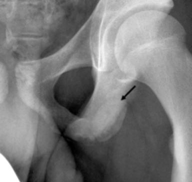 The right-sided ischial tuberosity is annotated (green) with the musculature overlaid on the contralateral