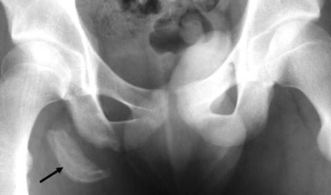 FIGURE 4. Young patient with displaced ischial tuberosity avulsion fracture.