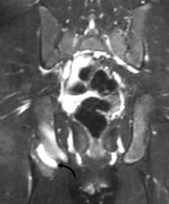 P view of the pelvis demonstrates a subtle case of chronic left ischial tuberosity avulsion with asymmetric cortical irregularity of the left ischial tuberosity (curved arrow).