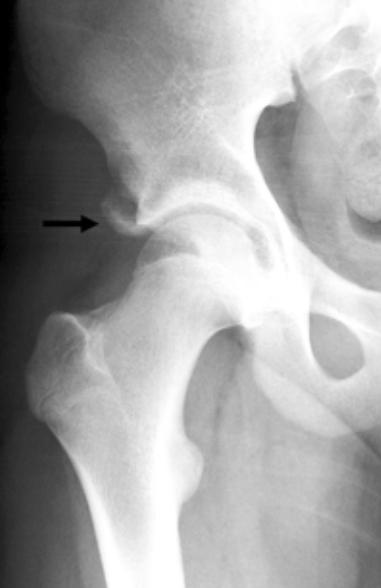 FIGURE 7. IIS avulsion injury. P view of the right hip shows an osseous fragment (arrow) at the IIS, consistent with avulsion injury. FIGURE 8. IIS avulsion injury with donor site.