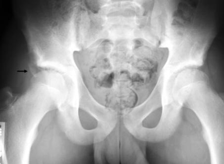 areful evaluation of the IIS to look for a donor site is recommended as an avulsed anterior superior iliac spine (SIS) fragment may displace far enough to appear as an IIS avulsion