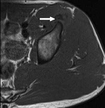 xial T1 () and T2 fat-supressed MR images () show osseous avulsion (arrow, ) of the IIS with associated edema (curved arrow, ) On radiographs, an osseous fragment is seen adjacent to