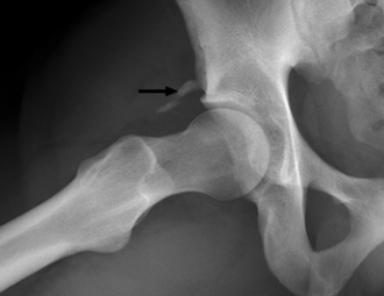 FIGURE 10. 23-year-old man with acetabular-indirect head of the rectus femoris avulsion injury after kicking a football.