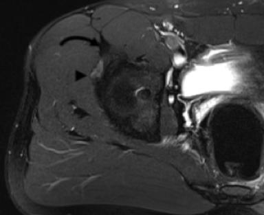 Differential considerations include an IIS vs. superior acetabular avulsion.