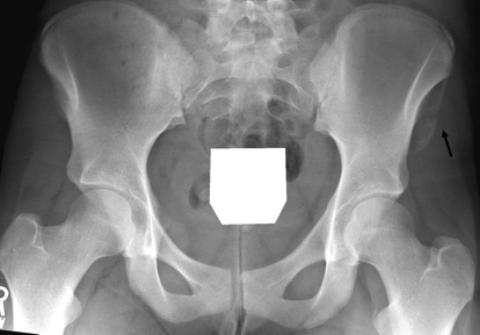 FIGURE 12. Young gymnast with SIS avulsion injury. P view of the pelvis () shows an avulsion of the left SIS (arrow).