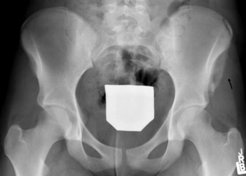 Following an additional injury 13 months after the initial injury, P radiograph of the pelvis () now shows a new avulsion of the right SIS (curved arrow) with the prior left-sided