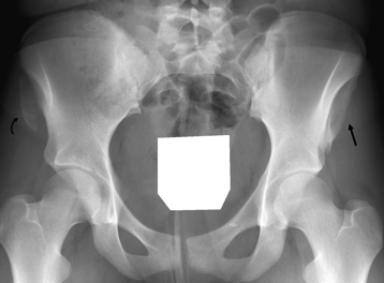 vulsion injuries at the symphysis pubis are uncommon and are usually from chronic overuse, although acute avulsions do occur rarely.
