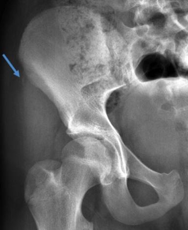 2 vulsion injuries at the symphysis pubis are usually seen within the spectrum of athletic pubalgia.
