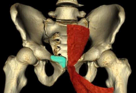 FIGURE 14. 3-D pelvic T reconstruction showing the adductor and rectus aponeurotic attachment at the pubic symphysis.
