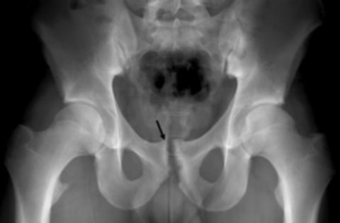 P radiograph of the pelvis in this patient with chronic injury shows widening and lysis at the pubic symphysis (arrow).