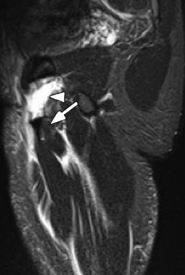 Sagittal T2 fat-suppressed MR image of the pelvis shows acute avulsion of the adductor tendons with associated retraction (arrow) and fluid gap (arrowhead).
