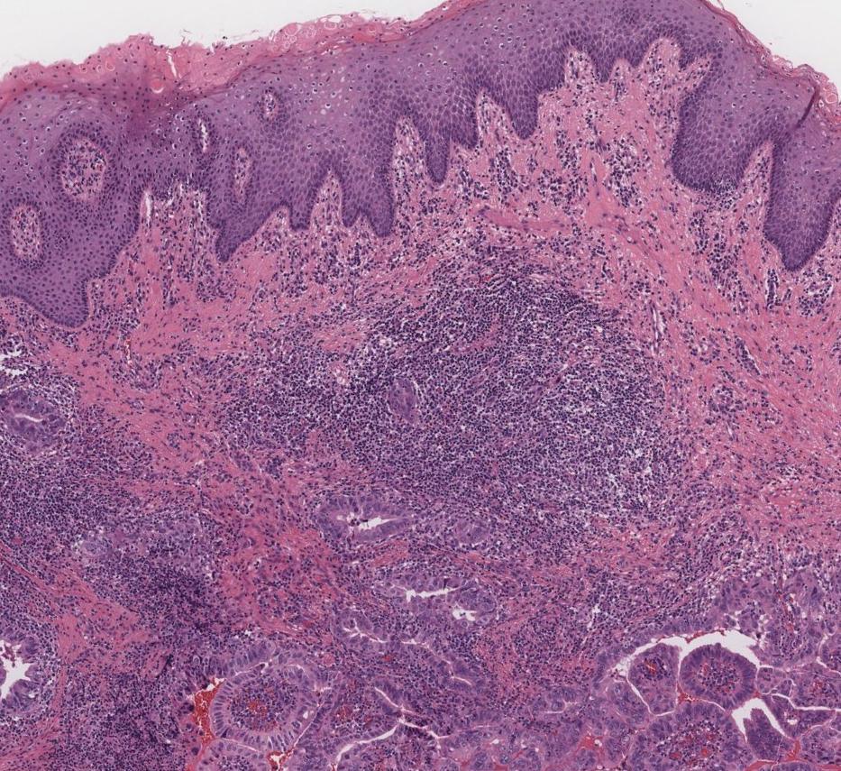 1 Case history: A 49 year-old female presented with a 5 year history of chronic anal fissure.