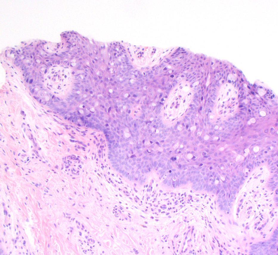 6 anal gland carcinoma, with strong CK7+, loss of CK5 and p63, and only focal CK20+ and CDX2+ cells.