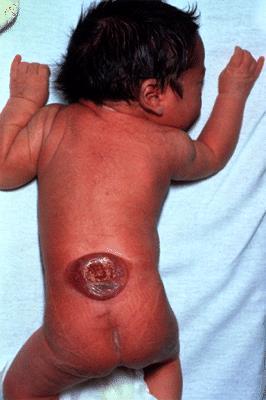 30. This figure depicts a fetal defect that can occur when inadequate amounts of folate are consumed during the first
