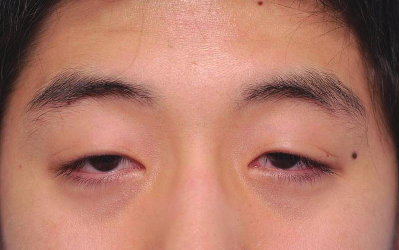 Vol. 43 / No. 2 / March 2016 Fig. 6. n 18-year-old man with bilateral severe ptosis () Preoperative photograph.