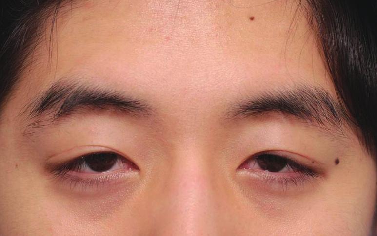 74 mm, respectively. The MRD1 of his left eye was 0 mm, the corneal exposure area was 48.5%, and the eyebrow height measurements (H1, H2, and H3) were 33.12 mm, 34.55 mm, and 35.38 mm, respectively.