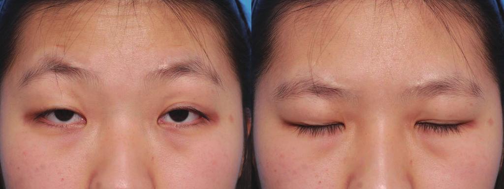 Kim WJ et al. Refinements of frontalis transfer Fig. 8. 20-year-old woman with bilateral severe ptosis () Preoperative photograph. The marginal reflex distance 1 (MRD1) of the right eye was 0.