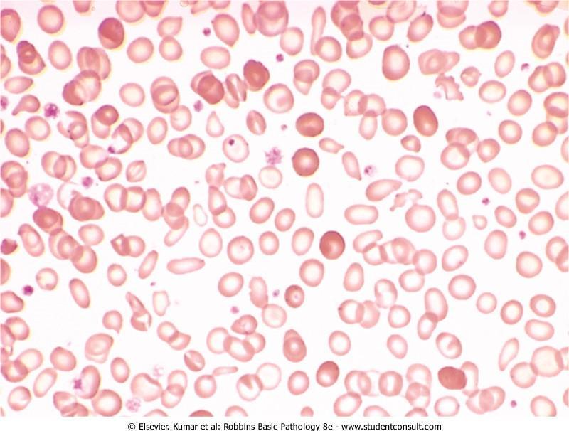Iron deficiency anemia: hypochromic mircocytic RBCs