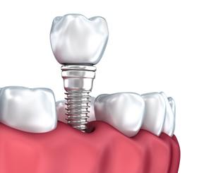 All dental implant options help ensure the structure around your missing teeth doesn t get compromised by keeping your teeth from shifting into incorrect positions. 2.