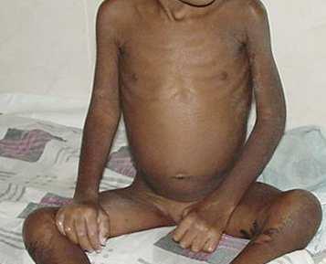 Children admitted to Malnutrition and Acute