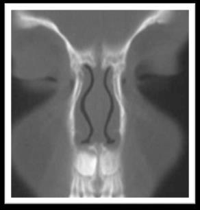 Nasal Dermoids Manifest as a simple cyst, a cyst with a sinus tract, or a sinus tract alone. may be intermittent discharge or infection.
