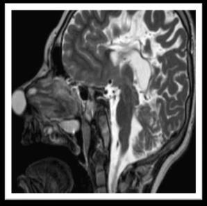negative Furstenberg test and do not transilluminate. Intracranial extension 4 45%. Nasal Dermoids CT and MRI provide complementary information.