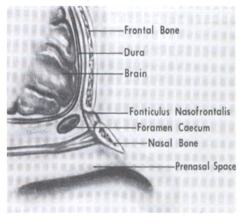 Embyrology Fonticulus frontalis space between the frontal and nasal bones
