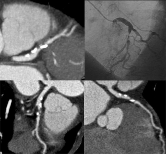 440 Clin. Cardiol. Vol. 30, September 2007 (A) (B) CT coronary angiography in patients with a low to intermediate likelihood of coronary artery disease.