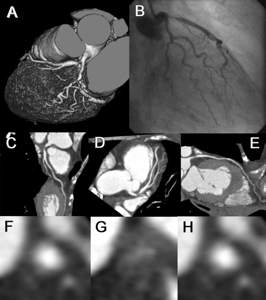 P. J. De Feyter et al.: CT coronary angiography: a current status report 441 FIG.