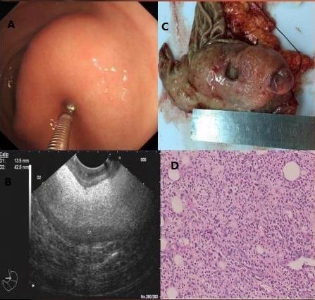 Fig. 1. A. The local part of the giant polyp in the gastric antrum under endoscopy led to the gastric outlet obstruction. B.