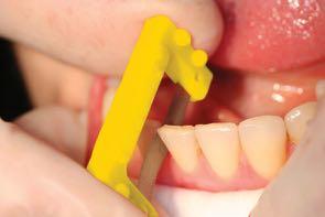 10 An innovative interproximal reduction system that makes interproximal enamel removal safer and more accurate without