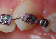 brackets as teeth align or wire slides round.