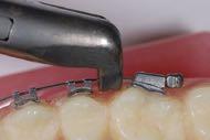 Problem #3 Safety Concerns Bonded molar tubes that debond can easily come off the