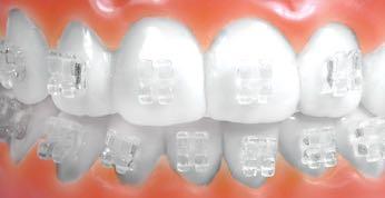 SPA brackets are transparent, allowing the natural shade of the patient s tooth to be seen through the bracket resulting in excellent patient aesthetics.