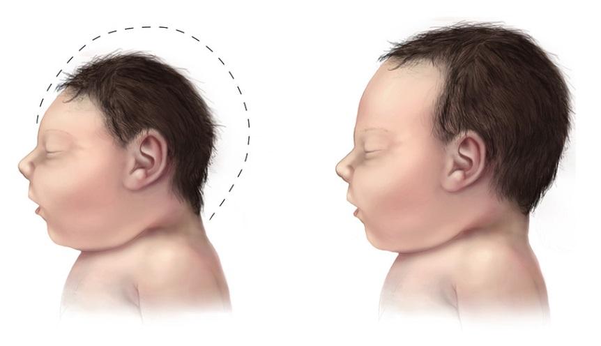 The Next Major Challenge: Microcephaly and Neurologic Deficit WHO May 2016 Report: Microcephaly, and other fetal malformations potentially associated with Zika virus infection or suggestive of