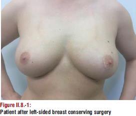 Breast conserving surgery Surgical management Quadrantectomy (excision