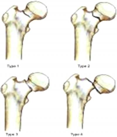 femur. Basal. GARDEN'S CLASSIFICATION, is a well known and accepted classification to comment on the stability and displacement of intracapsular fractures.
