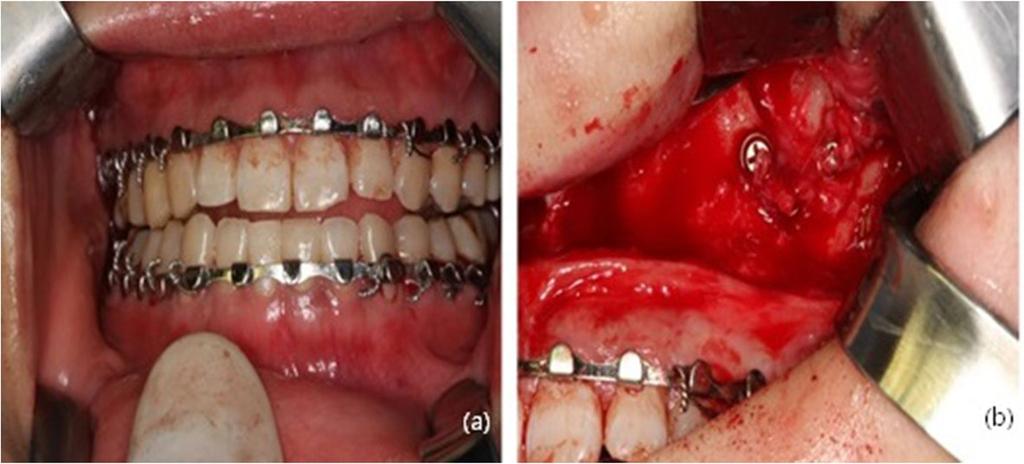placed in the edentulous area. The primary stability of the implants was excellent, and the implants were implanted using a one-step procedure.
