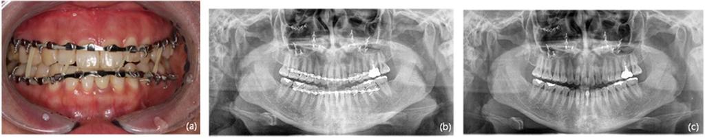 Kim et al. Maxillofacial Plastic and Reconstructive Surgery (2018) 40:27 Page 4 of 8 Fig. 3 a Clinical photograph at 1 month after operation showing resolution of the malocclusion.
