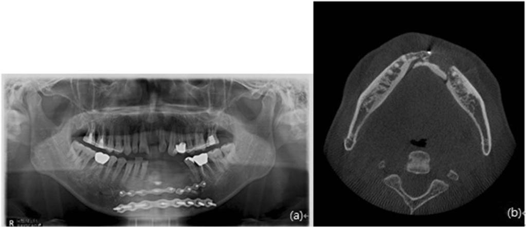 c Panoramic radiograph at 1 year after the operation Oneofthetwopatients(cases4and8)whohada fracture near the mandibular ramus had a comminuted fracture at the left mandibular ramus and fracture and