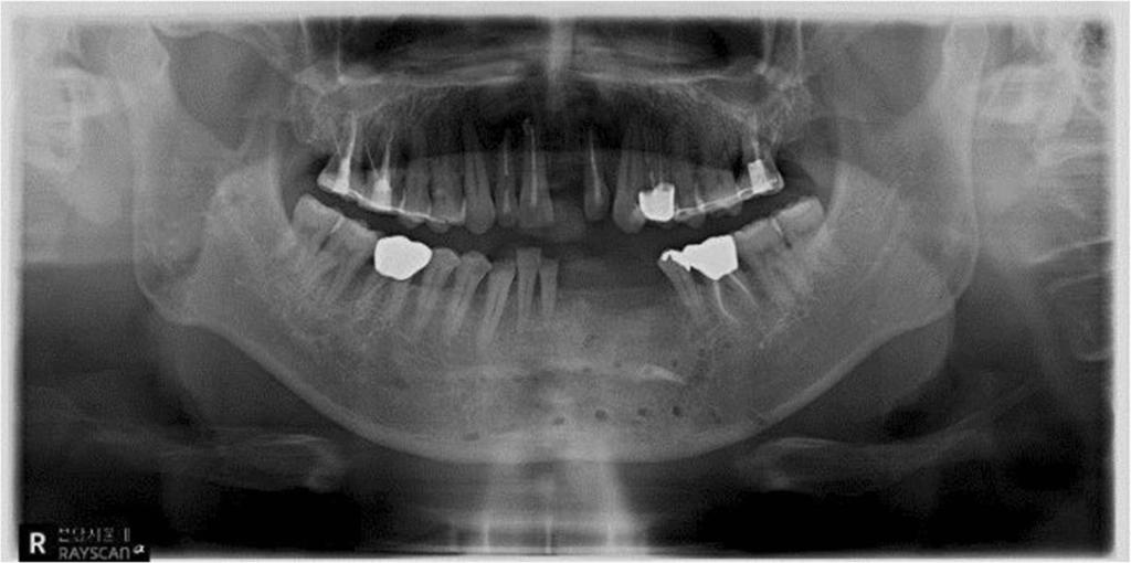 In summary, all the patients had fractures in the maxillofacial region accompanied by tooth fracture, dislocation, displacement, and alveolar bone fracture at the time of trauma.