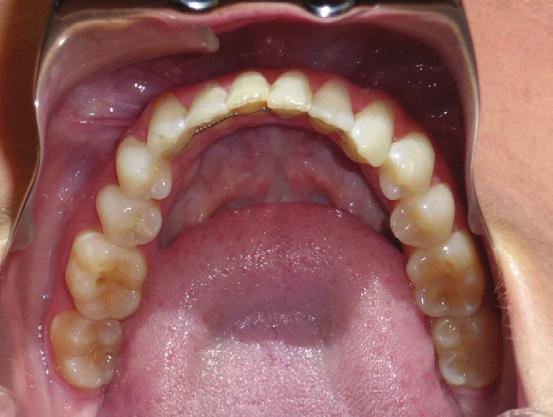 Some of the options available to clinicians include limited fixed appliances, with or without interproximal reduction (IPR), or removal of one lower incisor if more crowding warrants it. Fig.