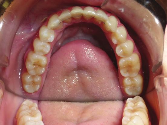 When I encounter a tightly coupled occlusion, slight tooth-size discrepancy resulting from a restored lateral incisor in the maxilla, and relapse, I m always concerned that just aligning the teeth