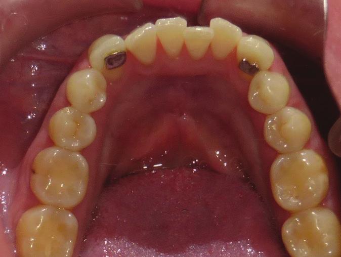 Case 2: Aligners and IPR The mother of a young Class III patient approached me about her lower incisor crowding.
