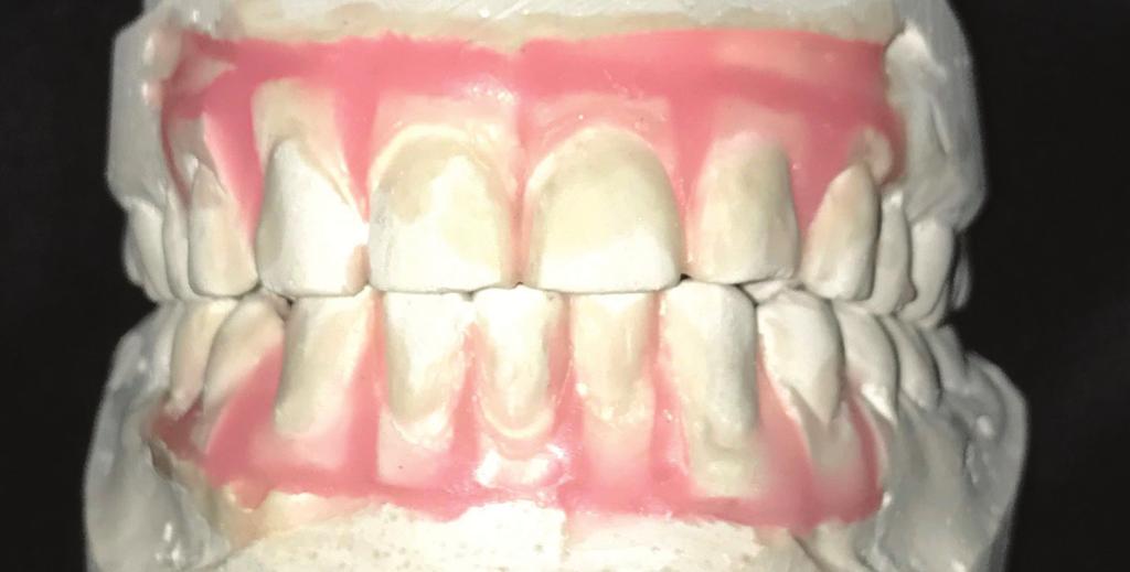 The wax-up indicated that removing a lower incisor would work but would require more aggressive IPR on the upper dentition, as evidenced in the casts.